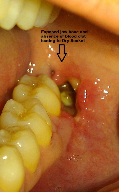 dry sockets in teeth