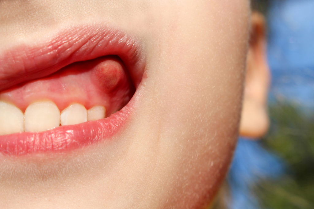 swelling-on-gums-the-child-dental-clinic-in-delhi