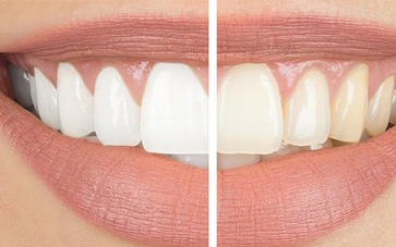 All That You Must Know About Cosmetic Dental Treatment In India