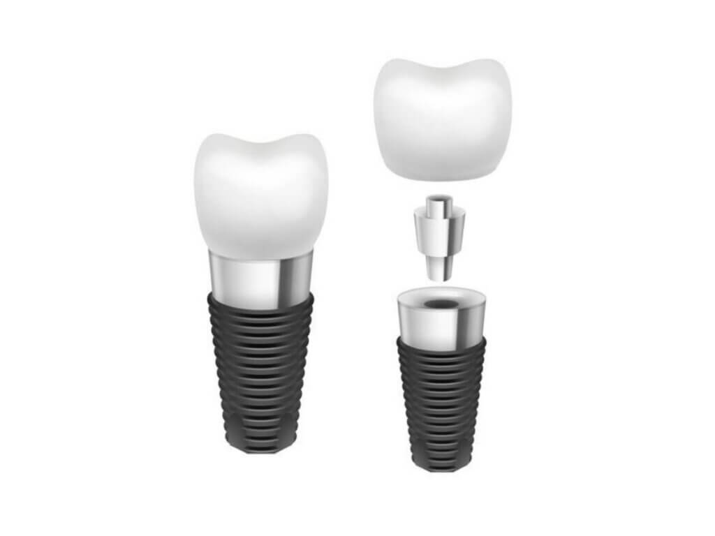 Dental Implants