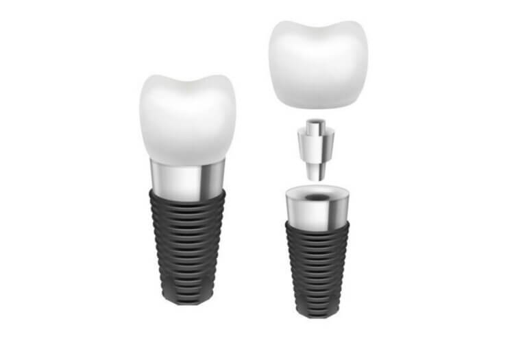 Dental Implants