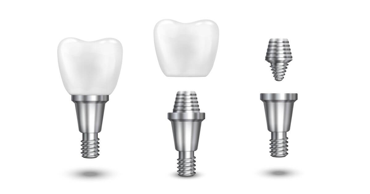 Understanding the Lifespan of Dental Implants