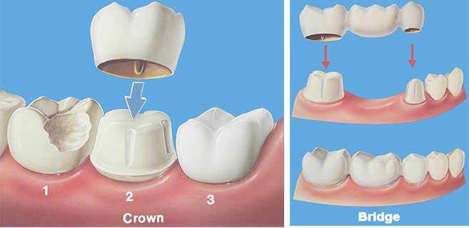 Dental Bridges And Crown