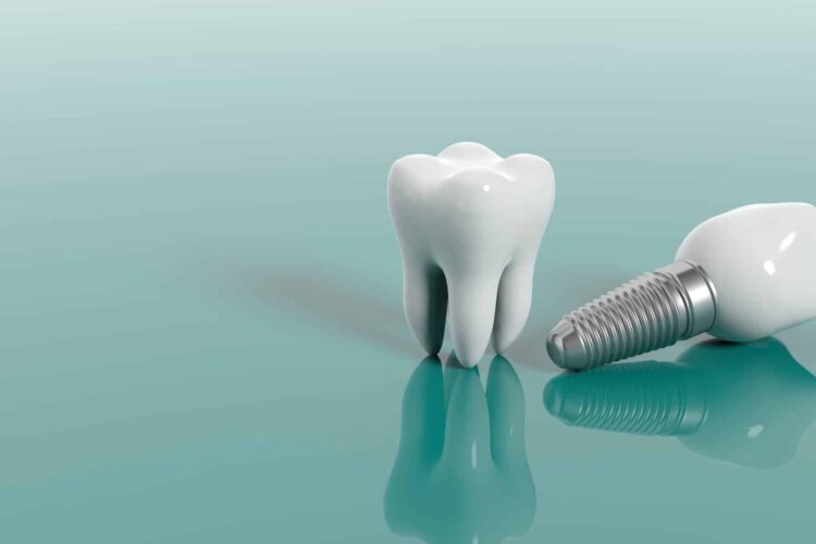 Dental Implants