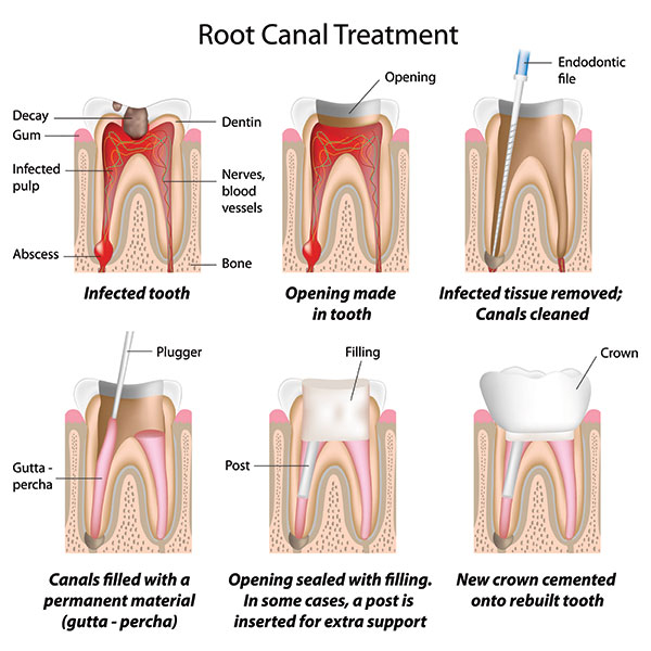 Root Canal Procedure