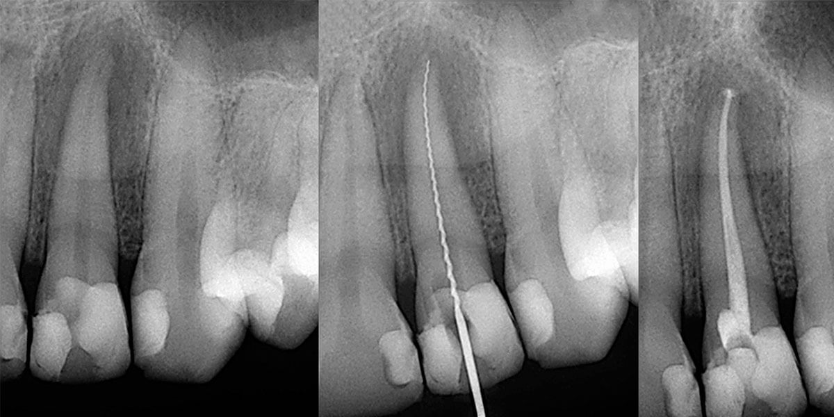 Root Canal Treatment X Ray