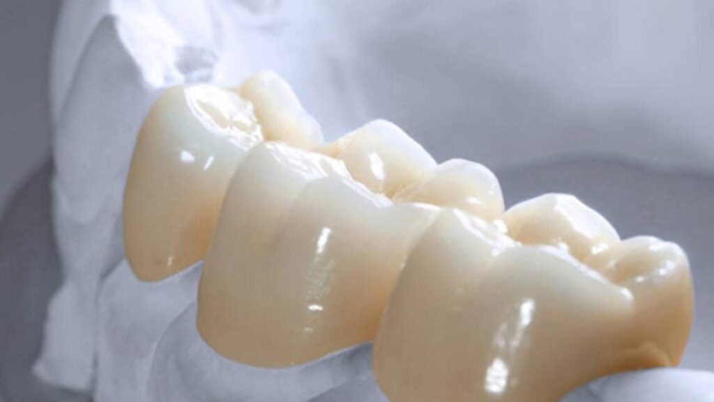 All Ceramic Crowns