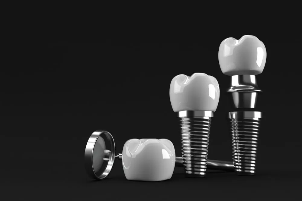 Dental Implants Delhi