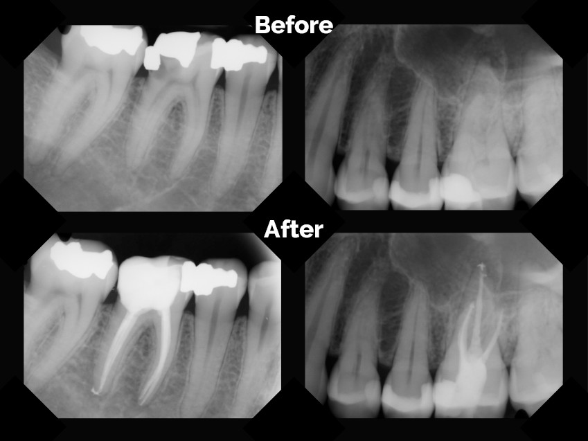 Root Canal Treatment Before And After