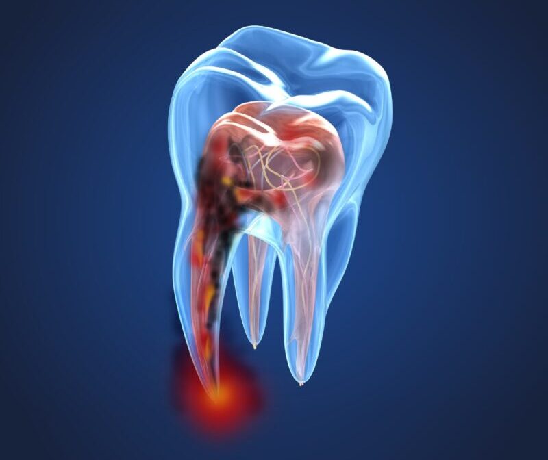 Root Canal Treatment