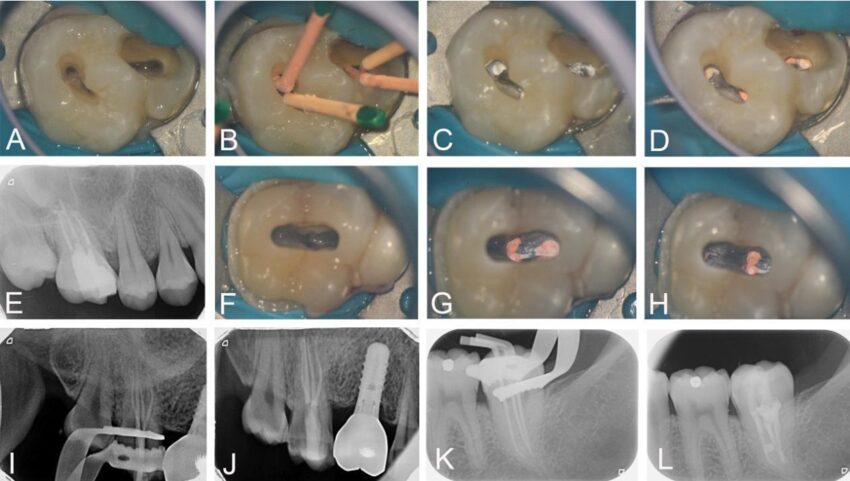 Root Canal Treatment Process