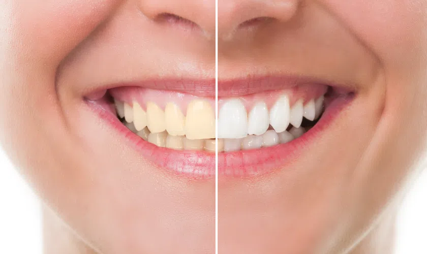 Teeth Whitening Treatment Delhi