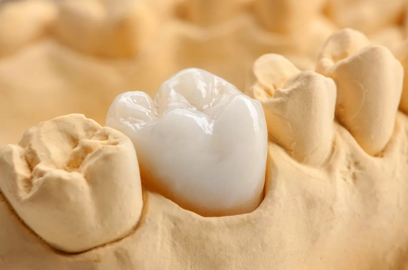 Zirconia Dental Crown Brisbane