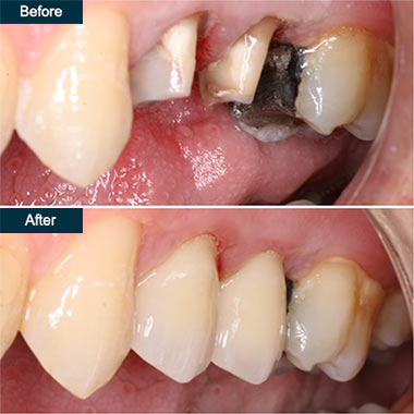 Before And After Teeth Grinding