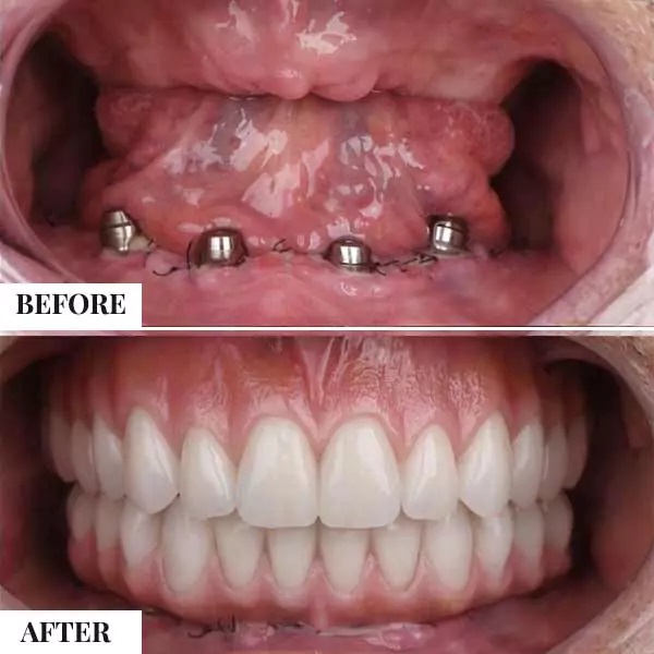 Delayed Implant Placement