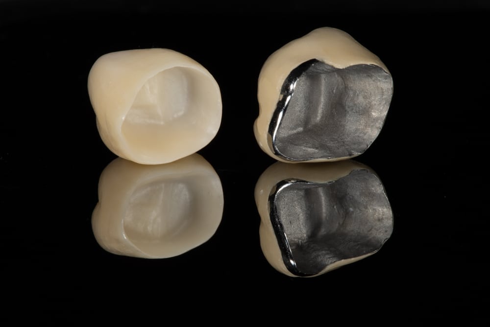 Metal-Ceramic Crowns