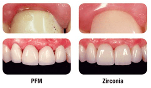 PFM Vs Zirconia