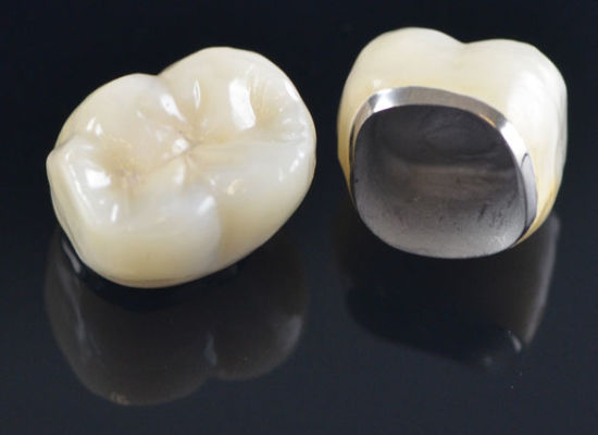 Porcelain Fused Metal Crowns