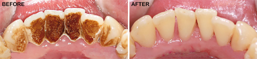 Before After Cosmetic Dentistry