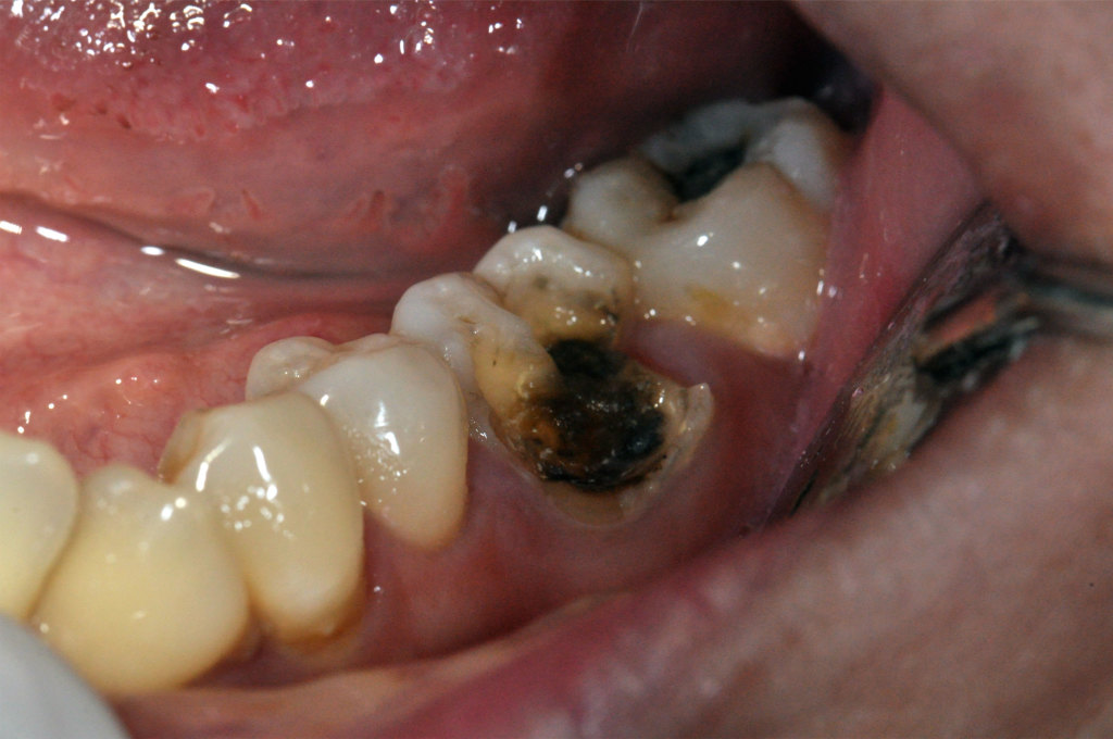 Dental Filling