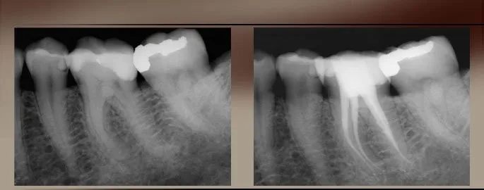 Dental X-ray