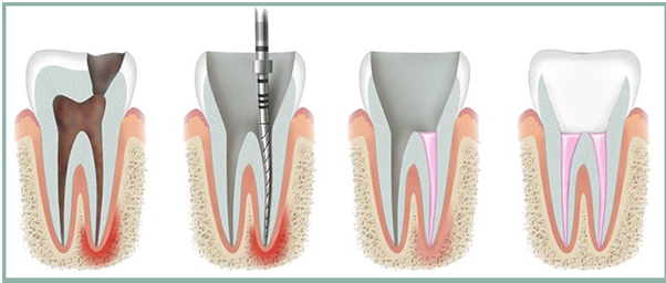 Root Canal Treatment