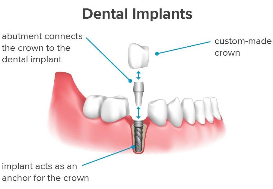 Dental Implants