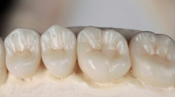 Durability Of All Ceramic Crowns