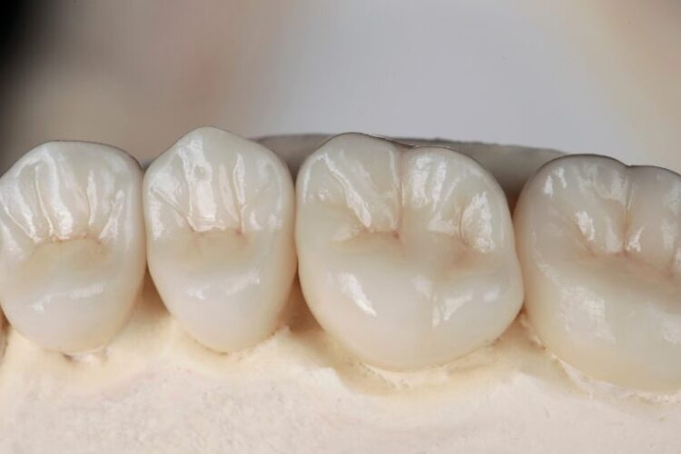 Durability Of All Ceramic Crowns