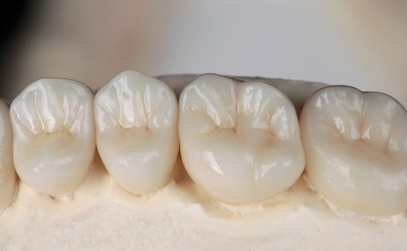 Durability Of All Ceramic Crowns