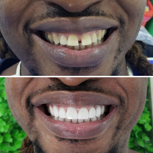 Karl Porcelain Veneers Before After