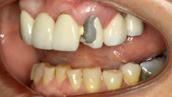 Metal Vs Ceramic Crowns