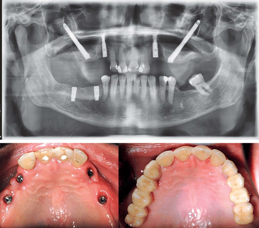 Orthopantomogram Patient With Extra Sinus Zygomatic Implants