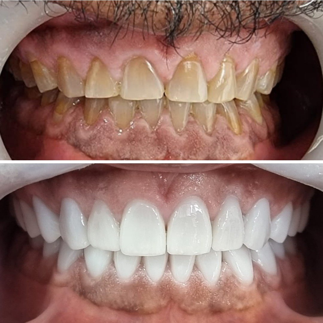 Porcelain Veneers Before After