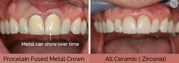 Procelain Fused Metal Vs Ceramic Crowns