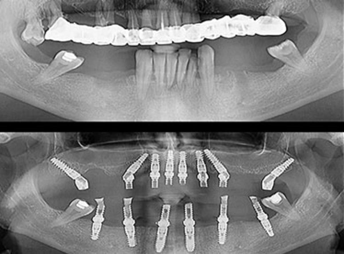 Zygomatic Implants