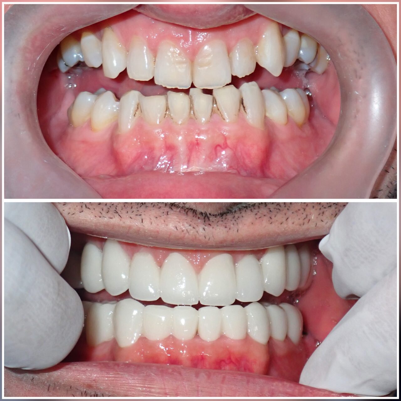 Normal Tooth Structure