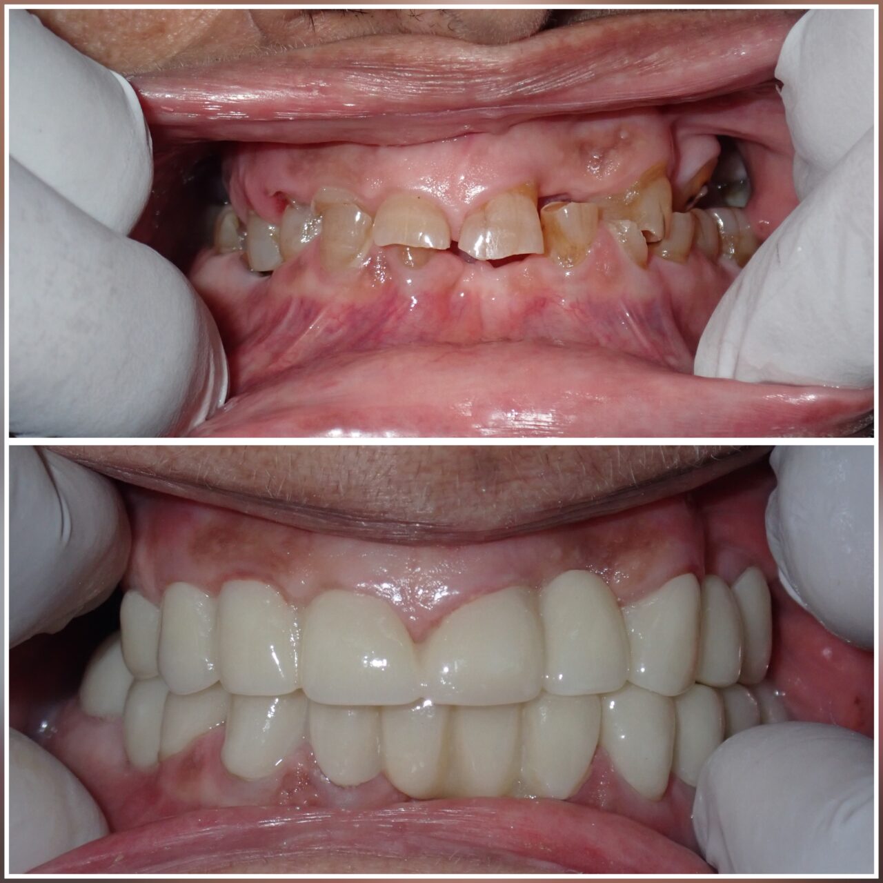 Normal Tooth Structure