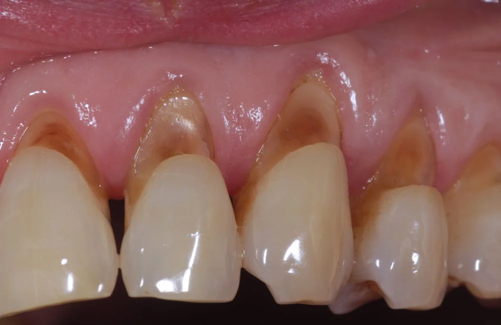 Abfraction Lesions