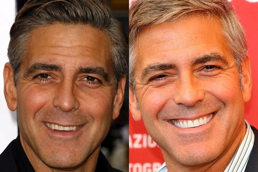 George Clooney Teeth Before And After