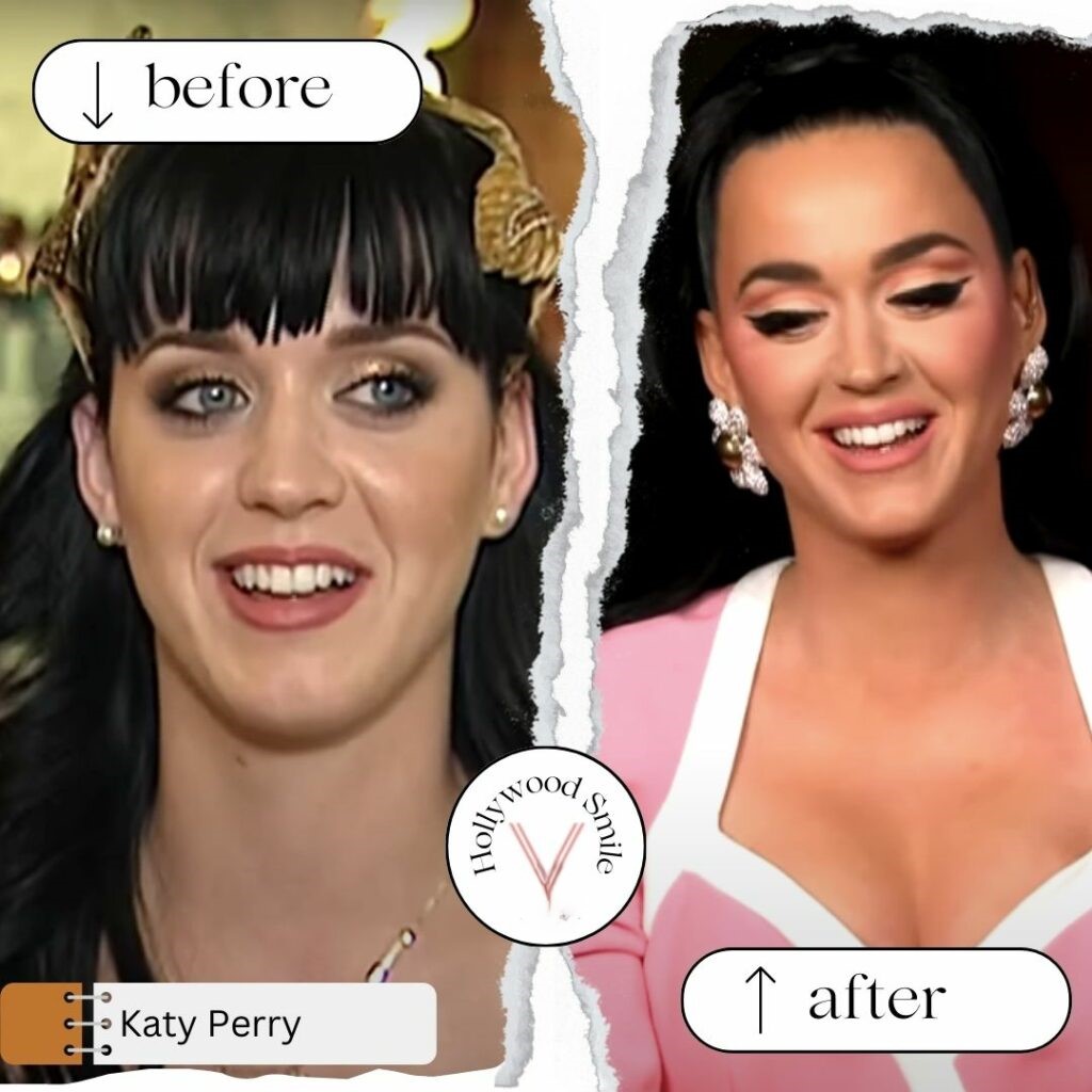 Katy Perry Smile Makeovers