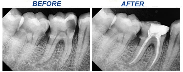 Root Canal Before After