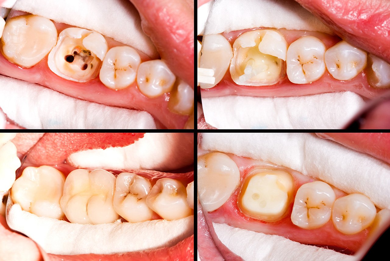 Root Canal Before And After