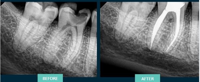 Root Canal Treatment On Molar Tooth