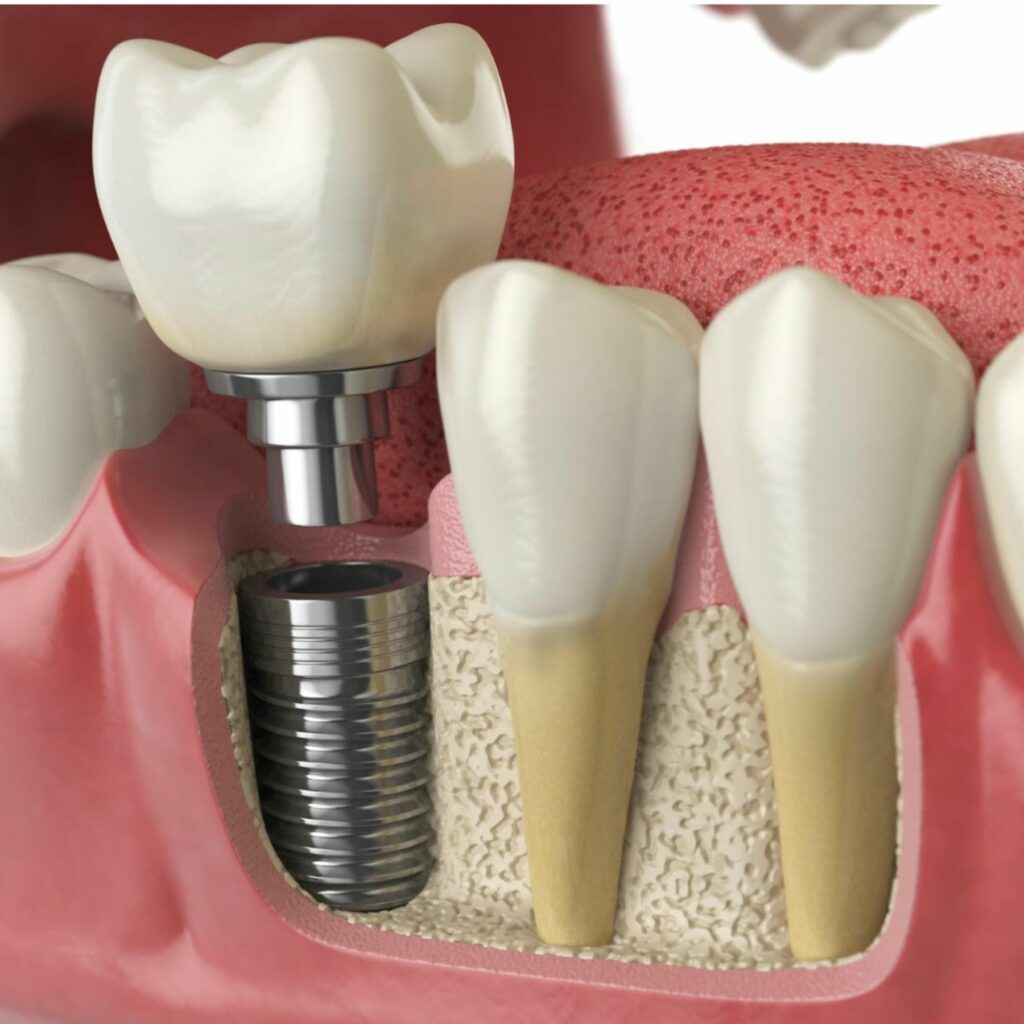 Dental Implant