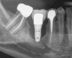 Dental Implants India