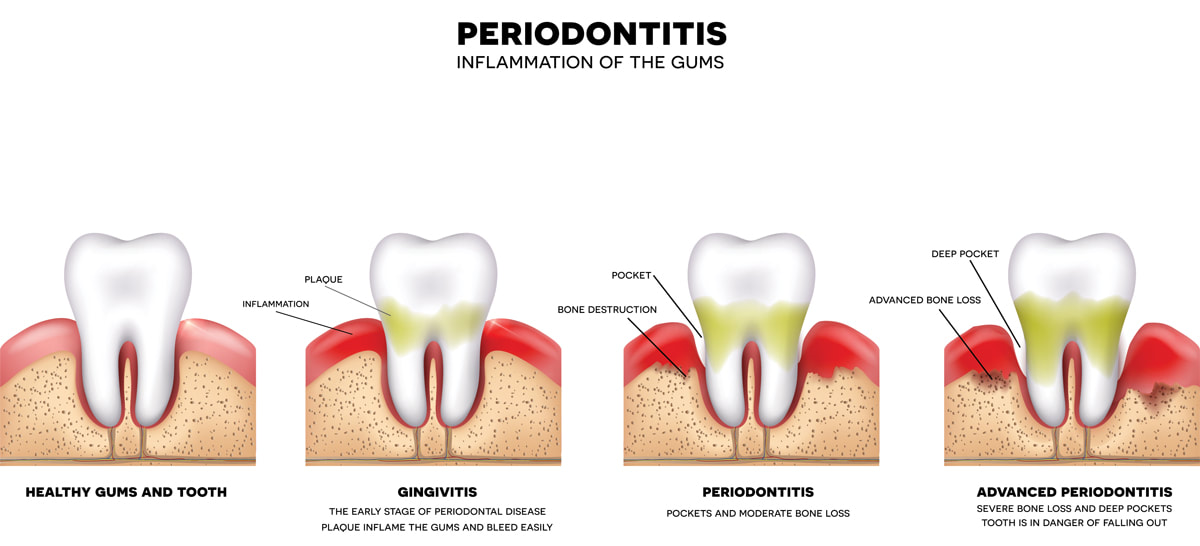 Periodontitis Inflammation Of The Gums