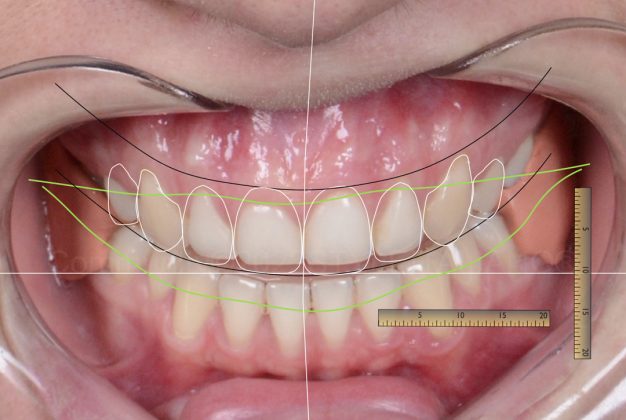 Porcelain Veneers