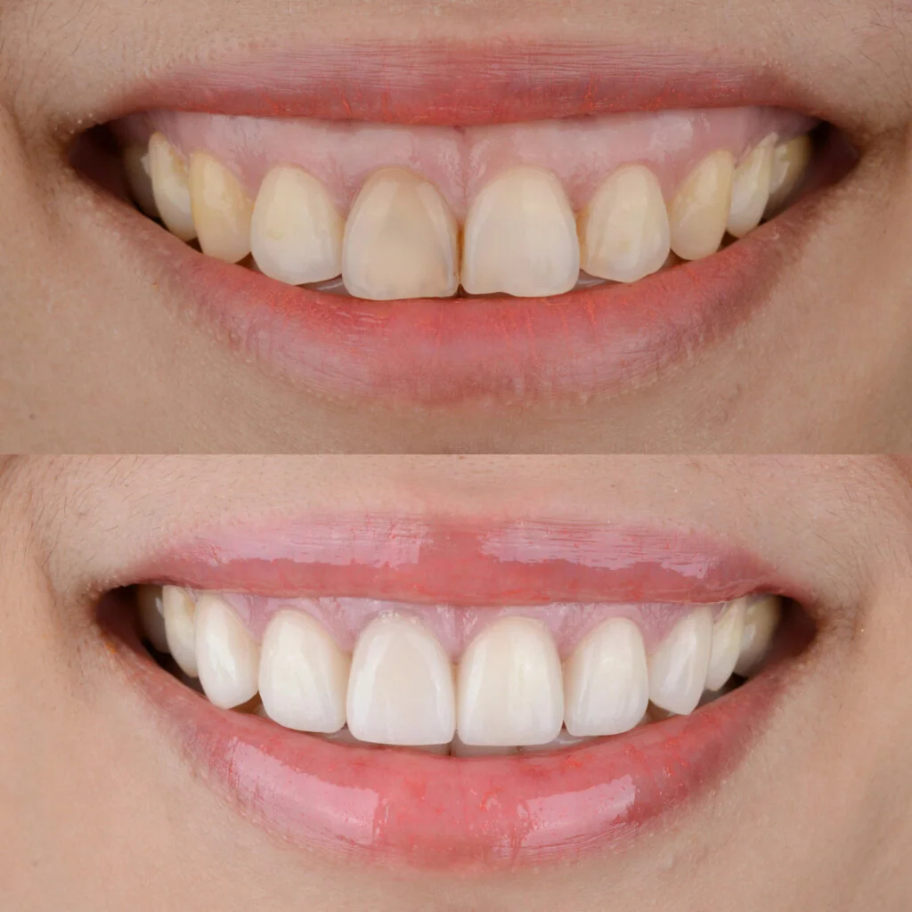 Role Of Gums In Smile Makeovers