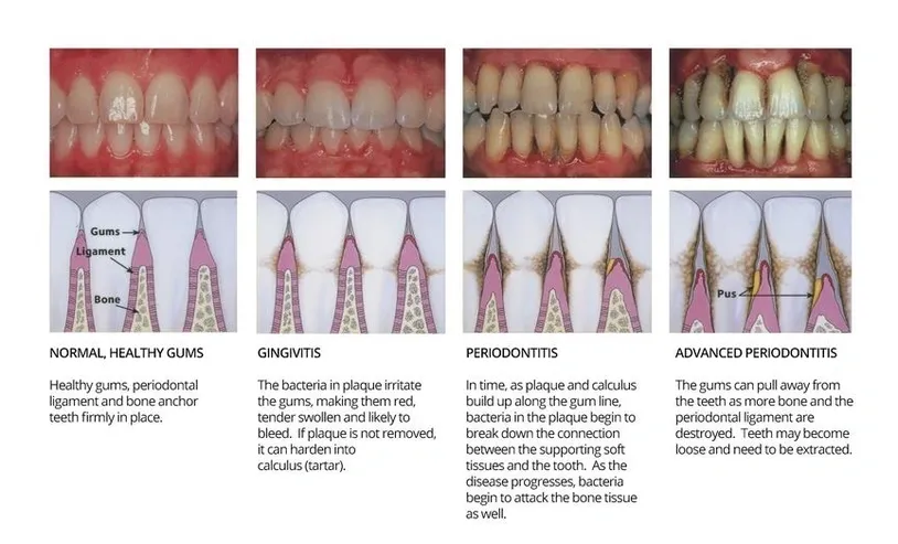 Stages Of Gum Disease